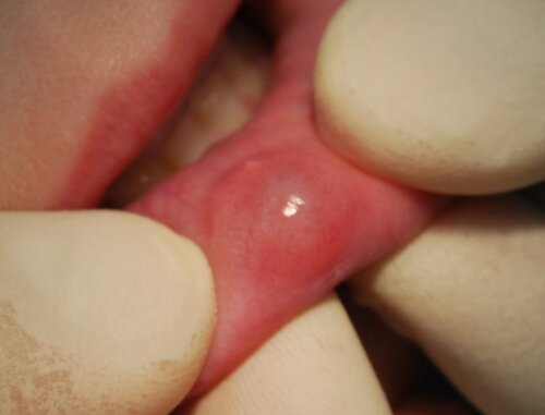 Последствия удаления кисты на губе
